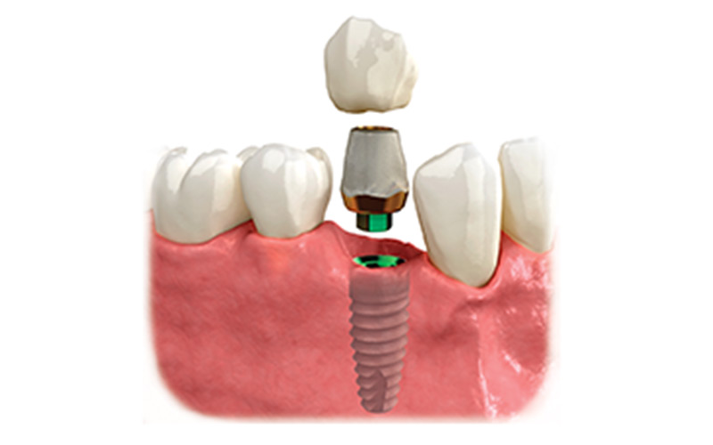 dental-implants-and-dentures